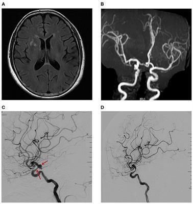 Case Report: A 62-Year-Old Woman With Contrast-Induced Encephalopathy Caused by Embolization of Intracranial Aneurysm
